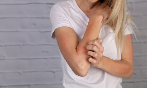 Femeie care se scarpina - mâncărime FOTO Shutterstock 