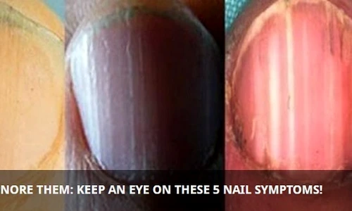 1 nu mai ignora niciodata aceste simptome care iti apar pe unghii iti pot spune ca ai grave probleme de sanatate ixzy jpg jpeg