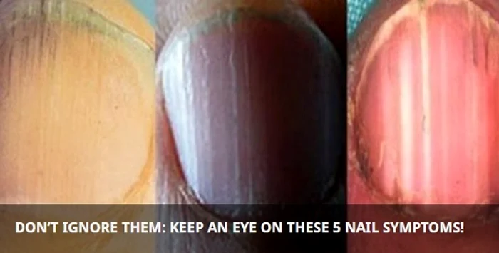1 nu mai ignora niciodata aceste simptome care iti apar pe unghii iti pot spune ca ai grave probleme de sanatate ixzy jpg jpeg