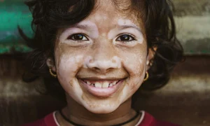 Tratament pentru vitiligo care iti imbunatateste vizibil aspectul pielii si iti echilibreaza sistemul imunitar jpg