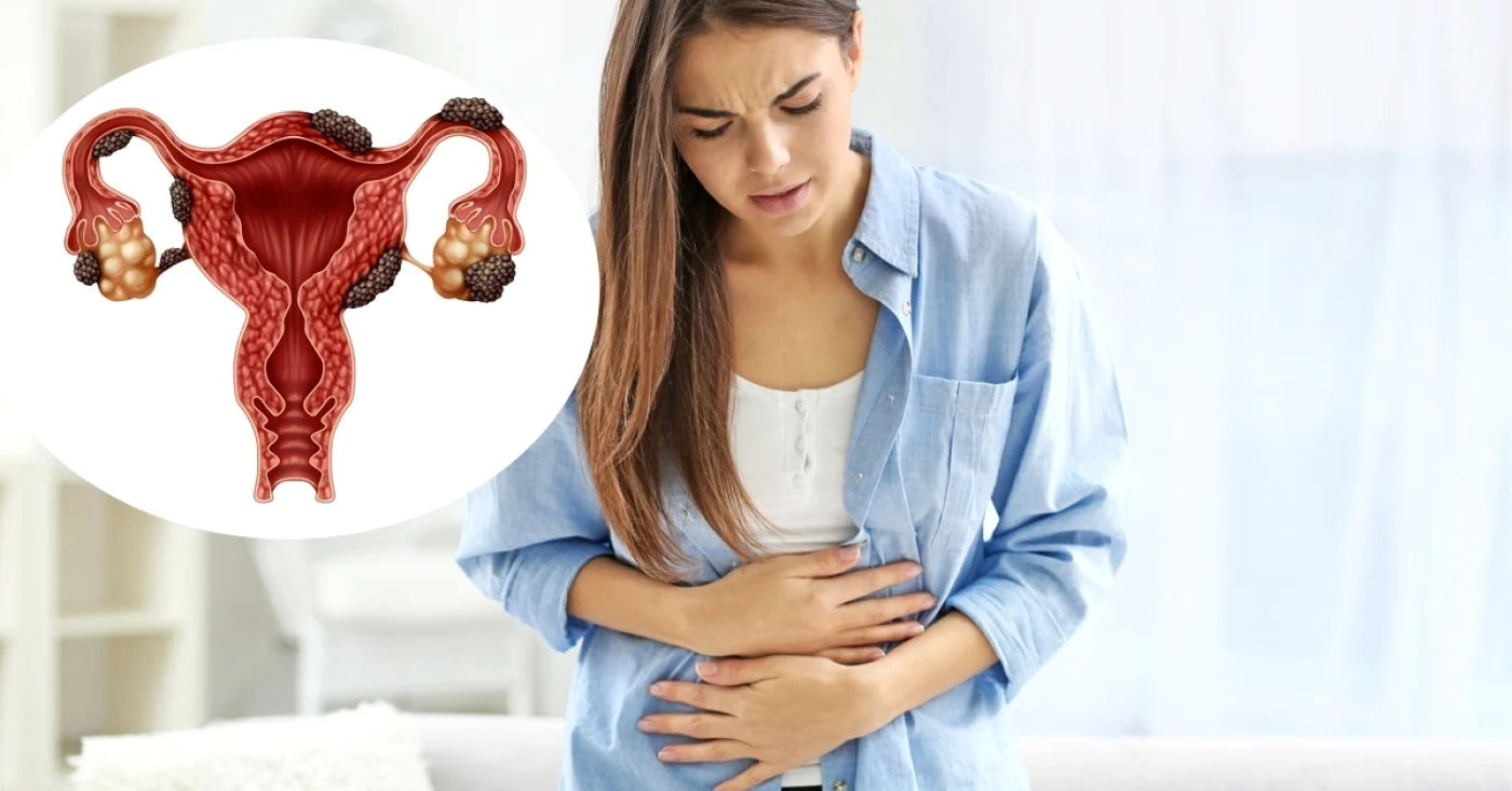Endometrioza