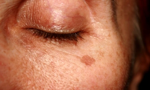 Ce boli ascund petele de pe piele  Învaţă să le recunoşti jpeg