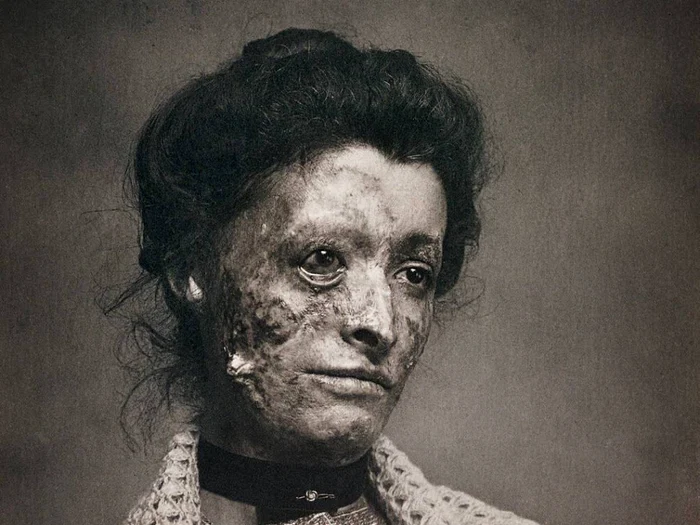 Lupus Vulgaris este cunoscută ca fiind o leziune dureroasă a tuberculozei care afectează regiunea facială.