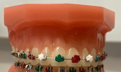 2 aparat dentar jpg jpeg