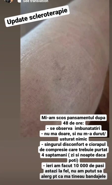 Așa arată piciorul lui Carmen, după tratament