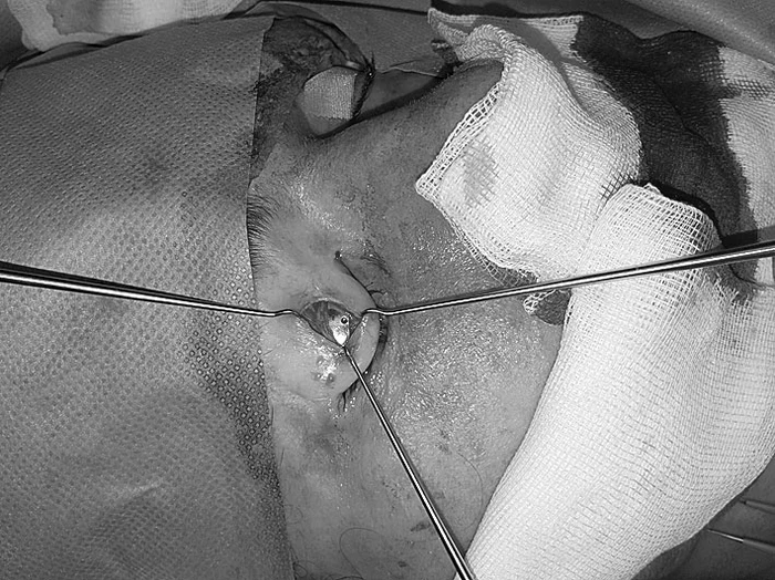 Pacientei i s-a implantat o proteză de aur care ajută ca pleoapa să se închidă gravitaţional