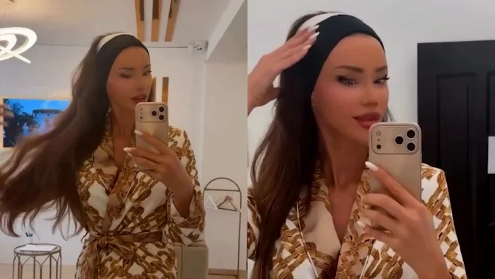 Bianca Drăgușanu, după intervenția de otoplastie. Foto: social media