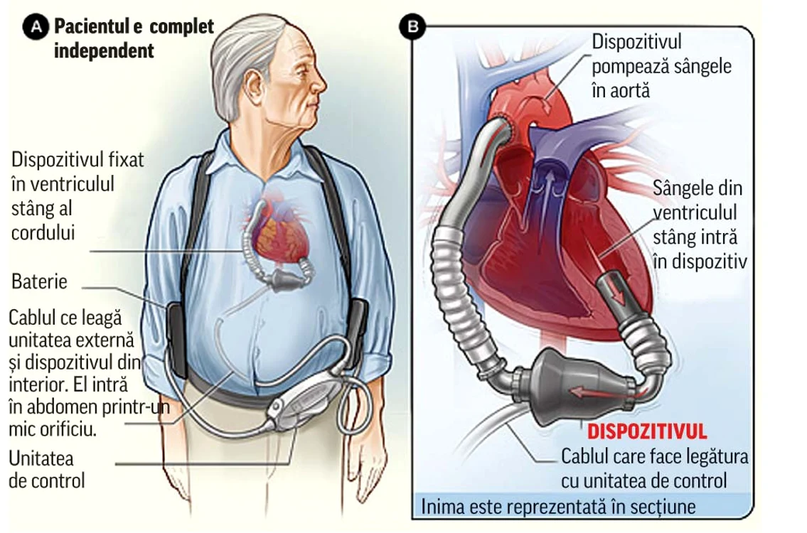 Practic, este vorba de o pompă care preia sângele şi îl trimite după aceea în aortă