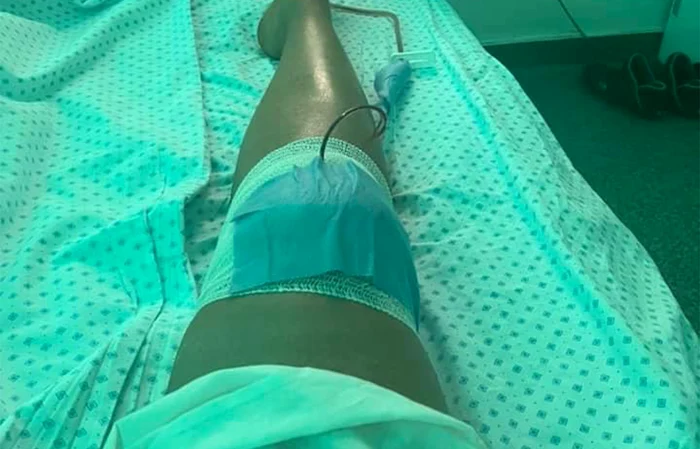 A avut ruptură de menisc de gradul 3 la dreptul. Foto: Arhivă personală