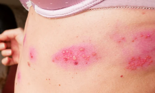 blistere_shutterstock 1729143838 jpg