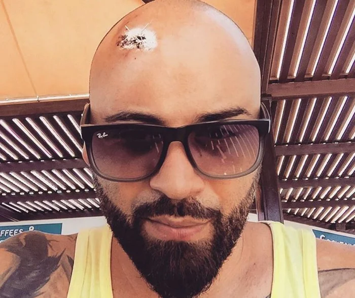 Cu toate că poartă ochelarii de soare, încă se văd urmele accidentului care se putea încheia tragicInstagram