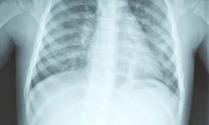 radiografie plamani jpeg