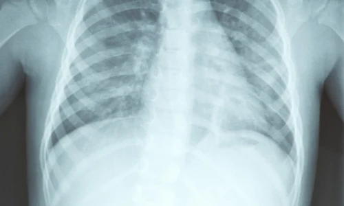 radiografie plamani jpeg