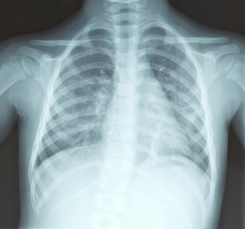 
    Agresivitatea cancerului pulmonar și depistarea lui târzie cresc riscurile de recidivă.www.clicksanatate.ro  