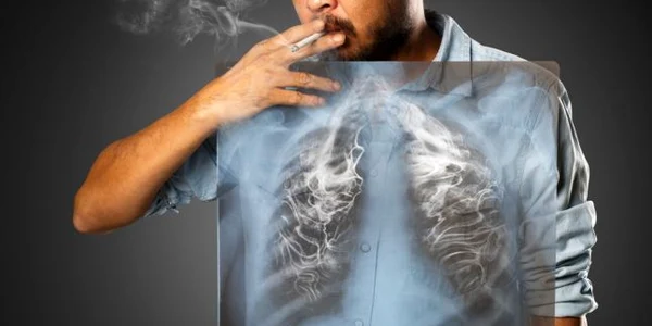 Plămânii unui fumător pe radiografie FOTO Shutterstock