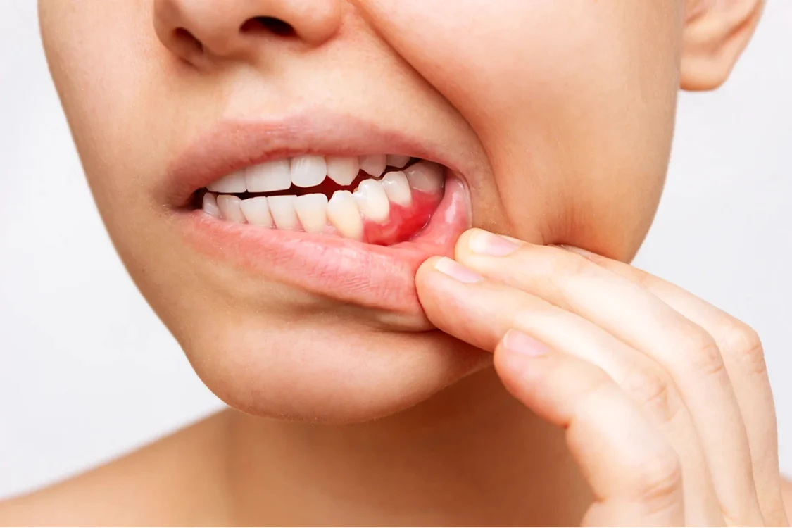 Cum arată retracția gingivală sau paradontoza primul semn ignorat de osteoporoză Foto Sunstar gum