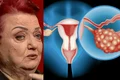 semnele cancerului ovarian jpg