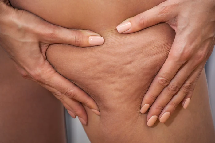 Celulita afectează peste 80% din femeifoto: Shutterstock
