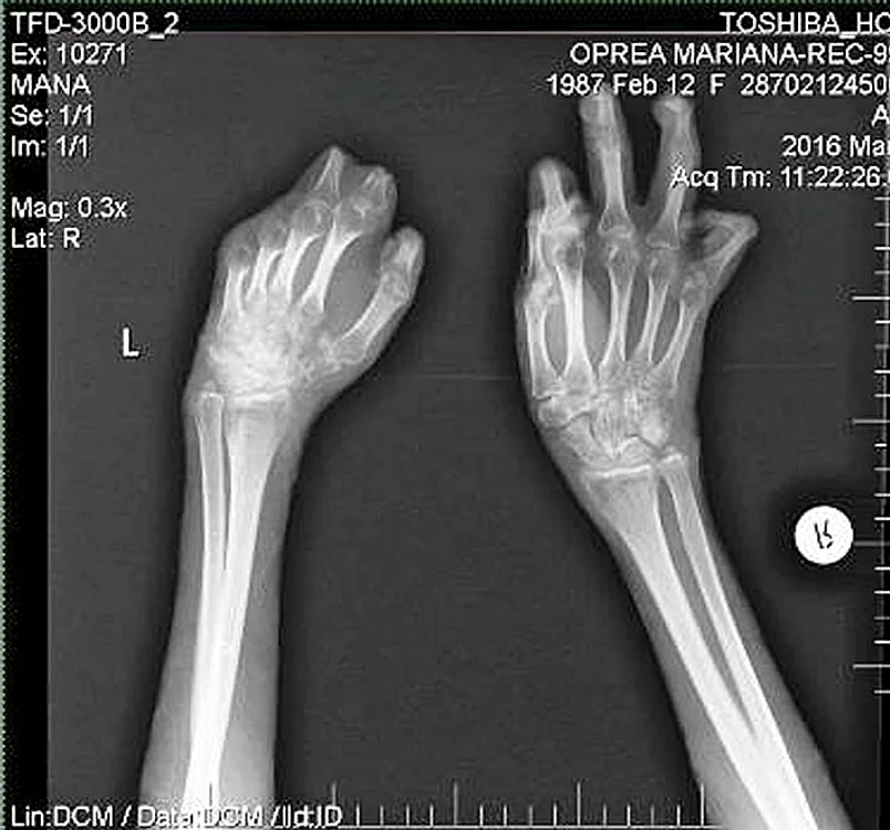 În radiografia făcută de medici se vede cum i-au fost amputate degetele
