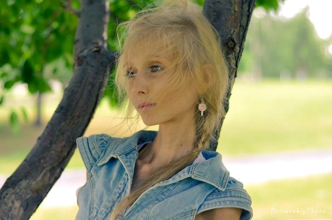
    Kseniya Bubenko este anorexică de mai mulţi ani, iar medicii nu îi dau multe şanse de supravieţuire  