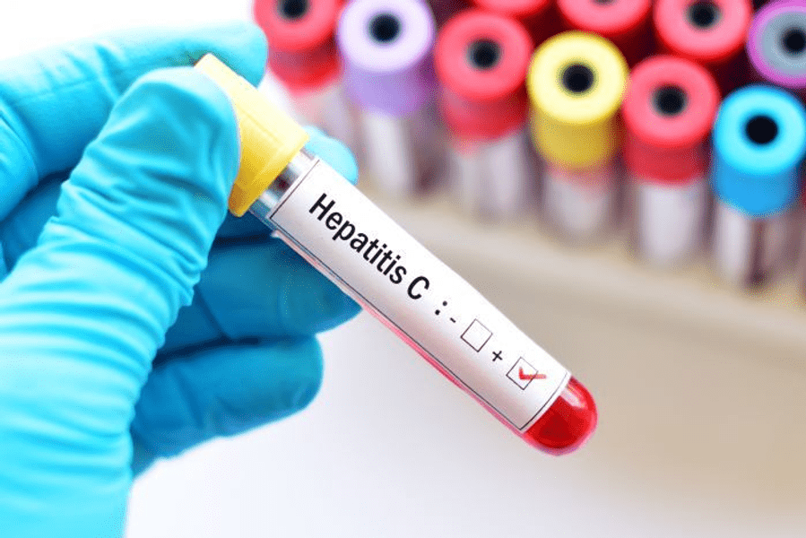 Aproape 3.000 de cazuri de hepatite depistate în doar un an și jumătate, în sudul țării