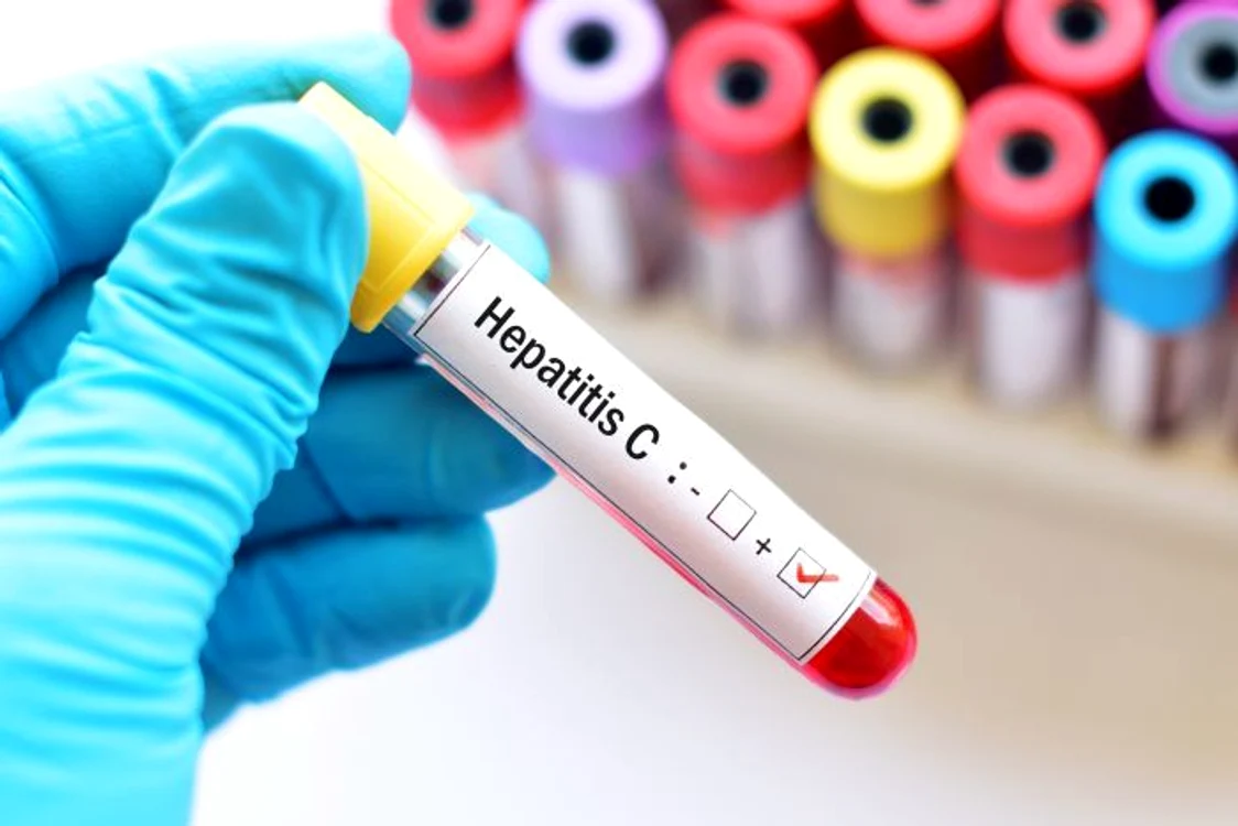 Numărul pacienților infectați cu virusurile hepatitice e în creștere Foto: Shutterstock