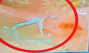 Bucăţile de sârmă,  filmate de medici  după ce le au scos  din colon jpeg
