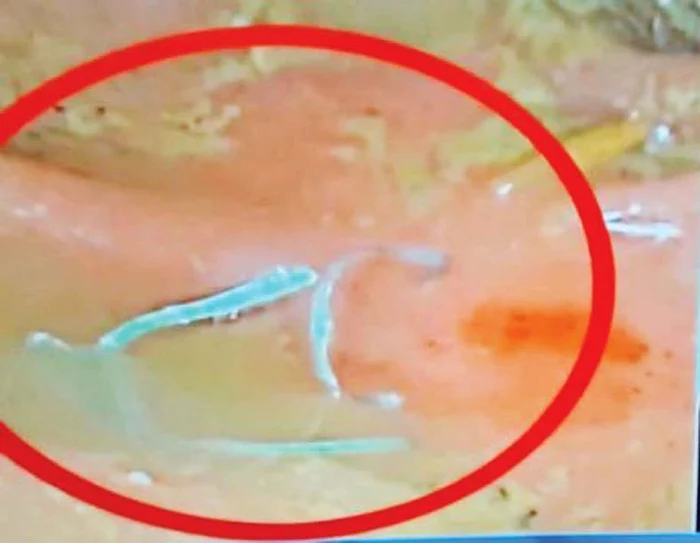 Bucăţile de sârmă,  filmate de medici  după ce le-au scos  din colon