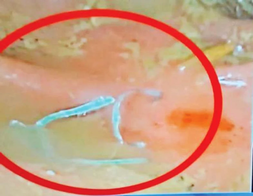 Bucăţile de sârmă,  filmate de medici  după ce le-au scos  din colon
