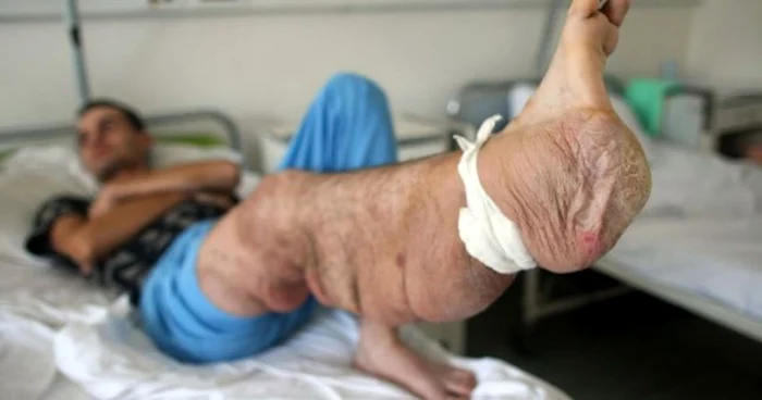 Dumitru Sârb s-a născut cu o malformaţie rară. Medicii i-au extras opt kilograme de ţesut FOTO Adevărul