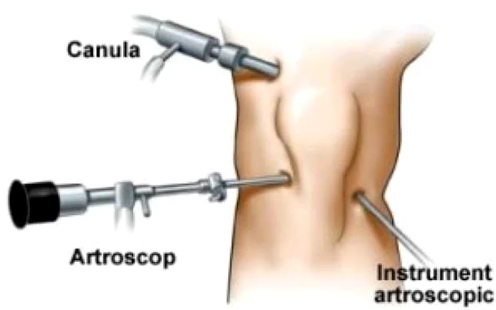 Artroscopia este o operaţie minim invazivă în urma căreia recuperarea este rapidă