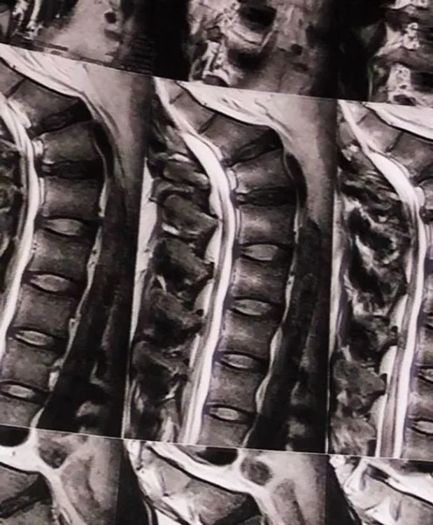 What's Up a arătat radiografia coloanei sale