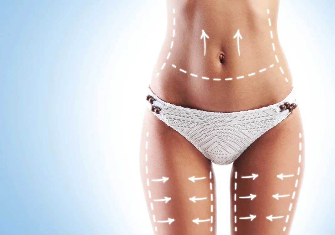 Liposucţia laser nu este o metodă de slăbire, ci doar de remodelare FOTO: Shutterstock