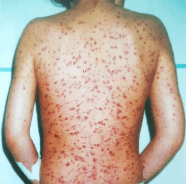 Copil de șapte ani cu varicelă foarte rară, internat la Spitalul de Boli Infecțioase din Timișoara
