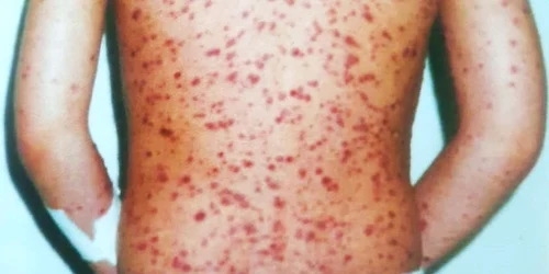 Varicelă FOTO Spitalul de Boli Infecțioase Timișoara