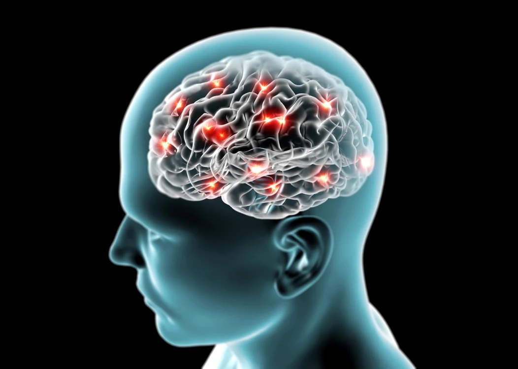 Rata mortalităţii din cauza accidentelor vasculare
cerebrale în România este de peste 1.000 de pacienţi la 100.000 de locuitori FOTO Shutterstock