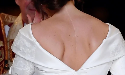 1 cicatricea printesei eugenie jpg jpeg