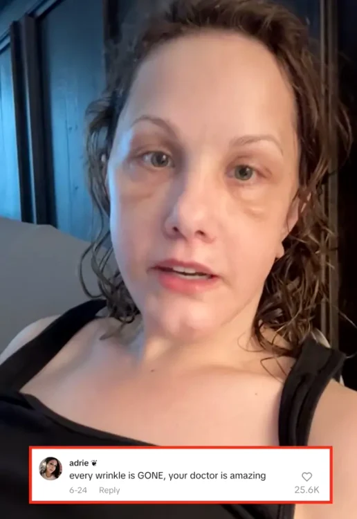 Transformarea unei femei i-a lăsat pe internauți cu gura căscată: „I-a șters 20 de ani!” Ea a apelat la lifting facial în Mexic 4 FOTO Michelle Wood
