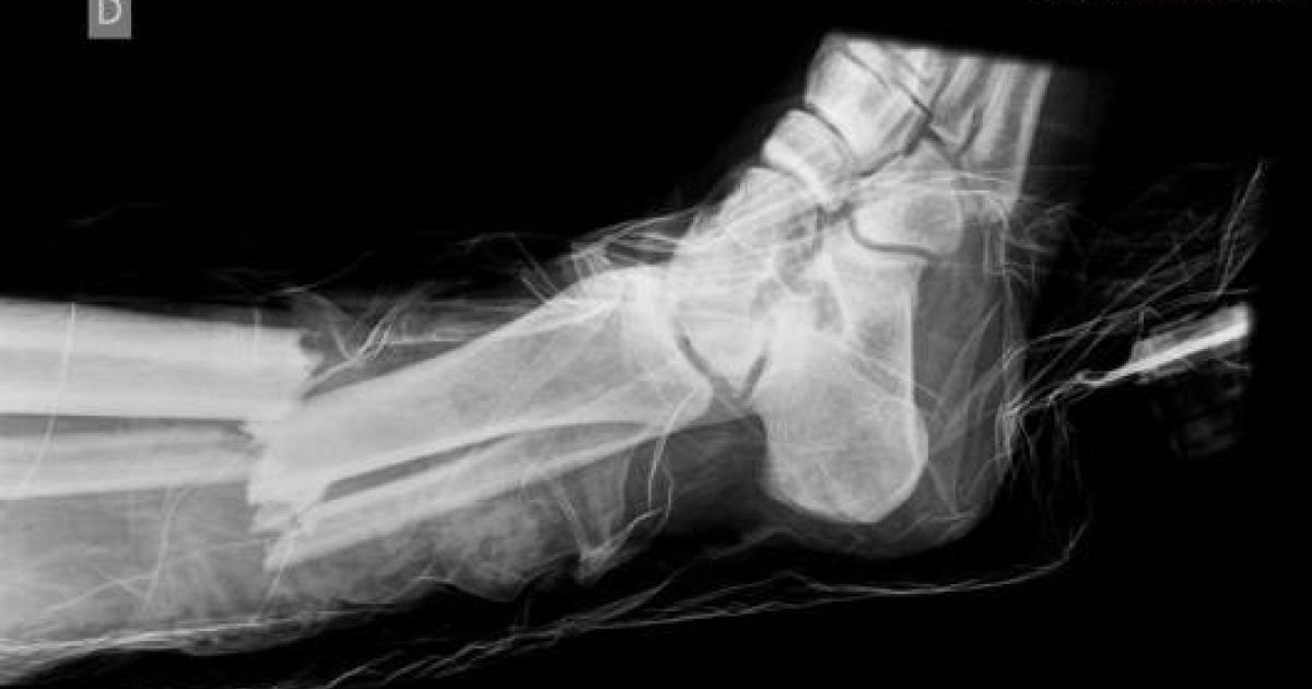 RADIOGRAFIE ŞOCANTĂ Uite cum arată piciorul fracturat al lui Wasilewski ...