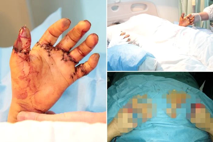 Degetele bărbatului au fost reatașate după o intervenție chirurgicală care a durat 13 oreFoto: mirror.co.uk
