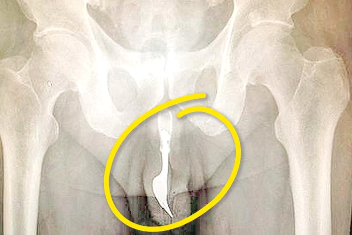 Şi-a băgat furculiţa-n penis pentru un orgasm mai intens