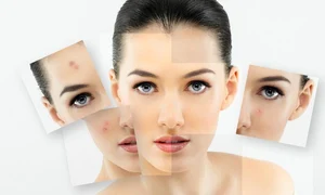 dieta pentru acnee si cosuri  ce alimente te ajuta sa scapi de aceasta problema jpeg