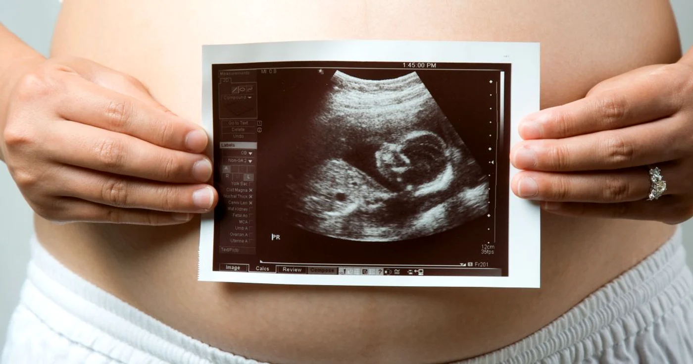 Una din circa 6000 de gravide poartă un copil cu trisomia 18 FOTO Shutterstock