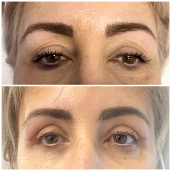 Blefaroplastie superioara, inferioara realizata de . Dr. Alina Mȋtcan Sursa foto . Dr. Alina Mȋtcan