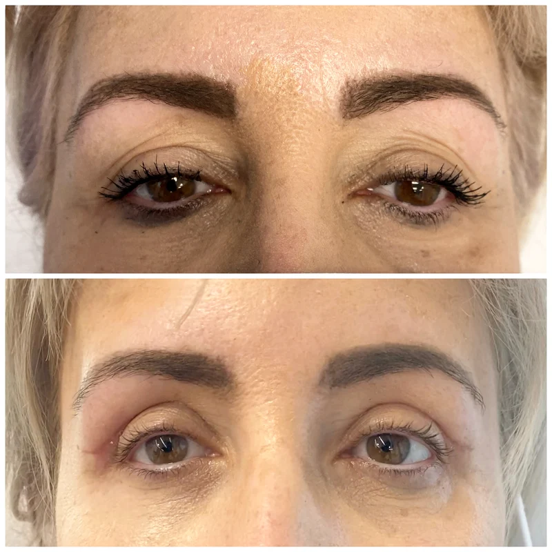 Blefaroplastie superioara, inferioara realizata de . Dr. Alina Mȋtcan  Sursa foto . Dr. Alina Mȋtcan 