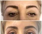 Blefaroplastie superioara, inferioara realizata de . Dr. Alina Mȋtcan  Sursa foto . Dr. Alina Mȋtcan 