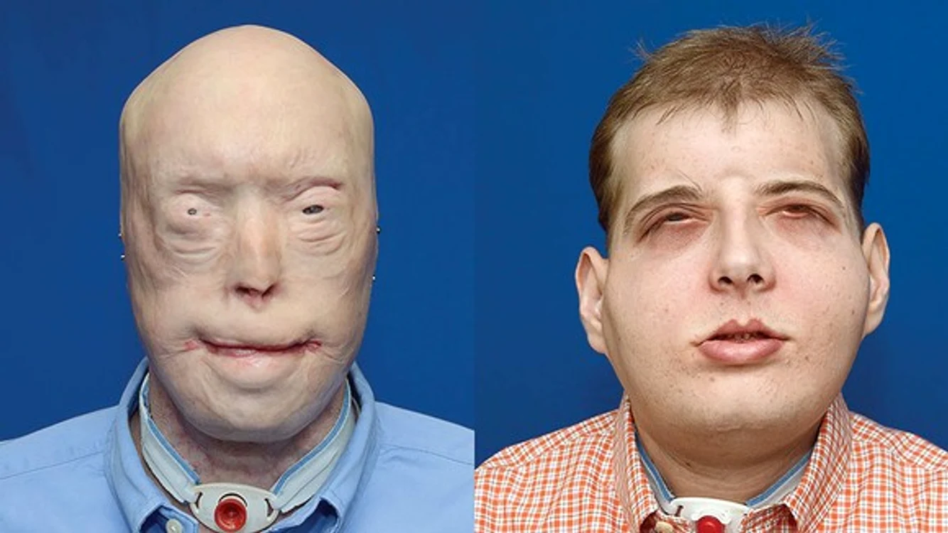 
    O echipă de medici din SUA a reușit să facă cel mai extins transplant de față din istorieFoto: Tech Insider  
