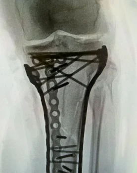 Radiografie Lindsey Vonn Foto/Instagram