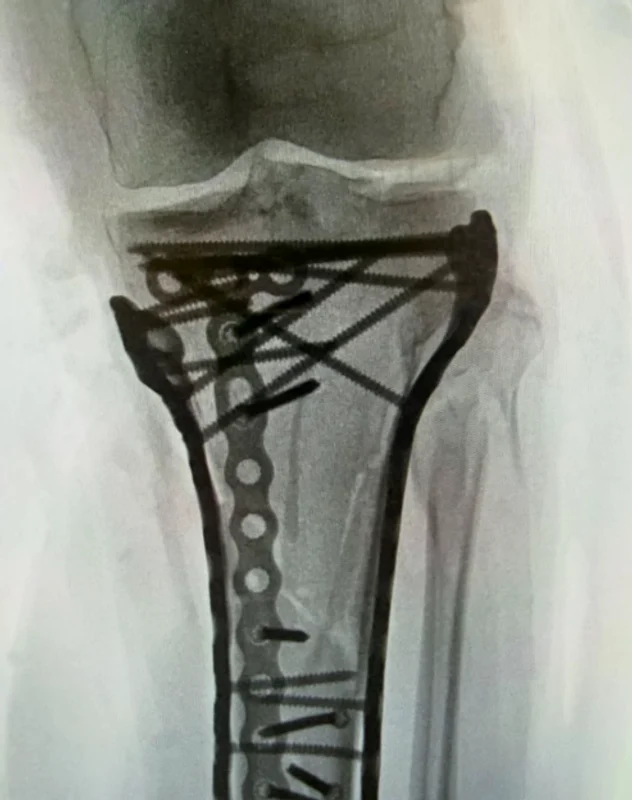 Radiografie Lindsey Vonn Foto/Instagram