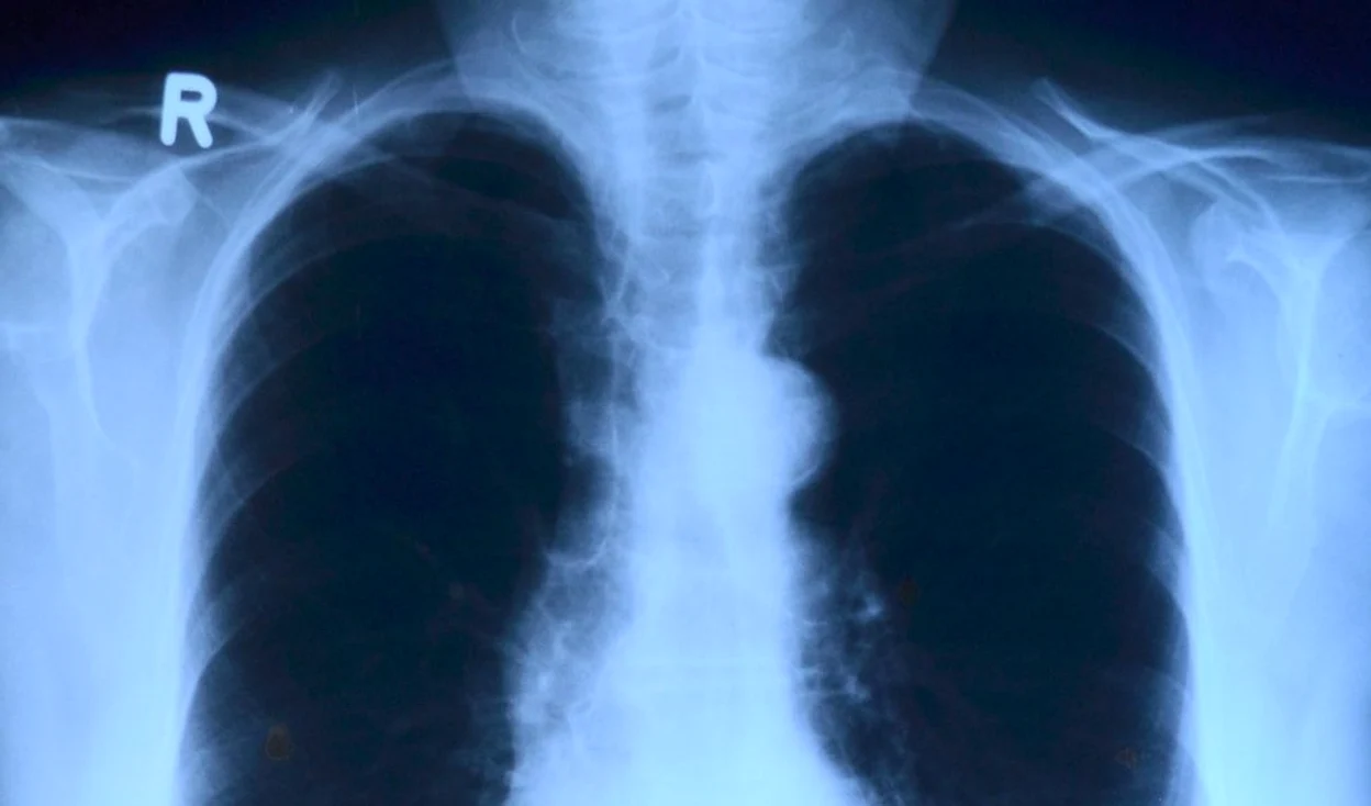 Startup-ul XVision a lansat prima aplicație din România pentru radiografii pulmonare
